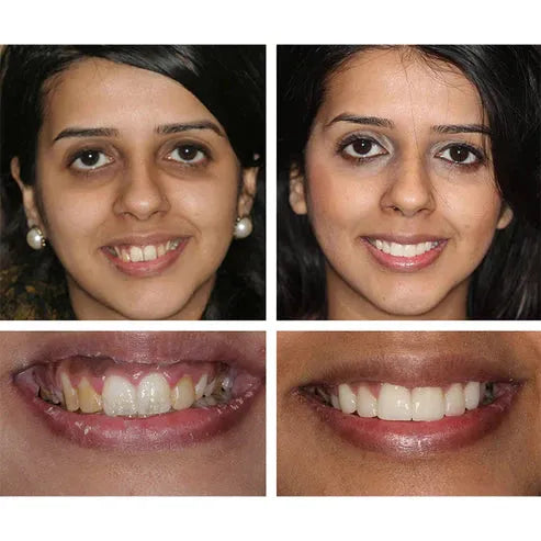 ✨TEETH WHITENING ESSENCE🔥HOT SALE🔥