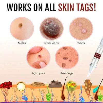 Skin Spots Warts Remover Facial Cleaning Pen