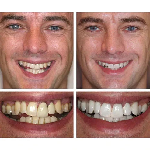 ✨TEETH WHITENING ESSENCE🔥HOT SALE🔥