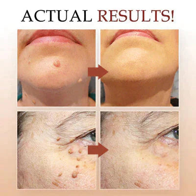 Skin Spots Warts Remover Facial Cleaning Pen